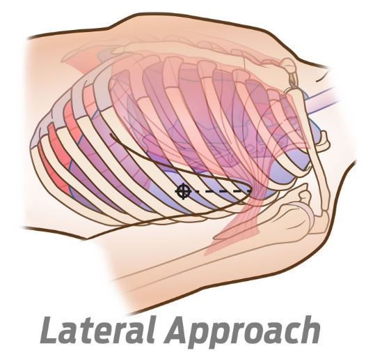 SPEAR - Simplified Pneumothorax Emergency Air Release - North American Rescue®