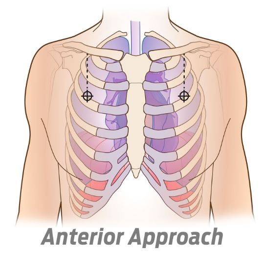 SPEAR - Simplified Pneumothorax Emergency Air Release - North American Rescue®