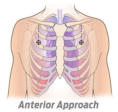SPEAR - Simplified Pneumothorax Emergency Air Release - North American Rescue®
