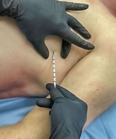 SPEAR - Simplified Pneumothorax Emergency Air Release - North American Rescue®