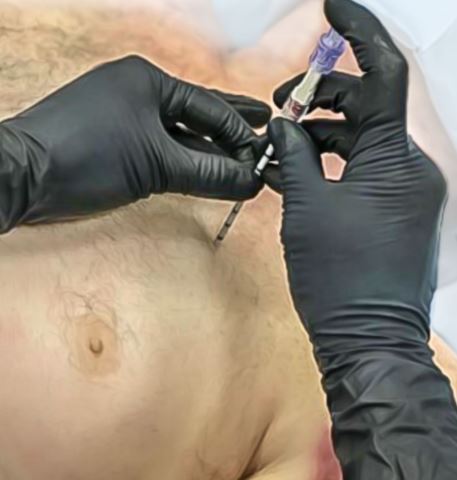 SPEAR - Simplified Pneumothorax Emergency Air Release - North American Rescue®