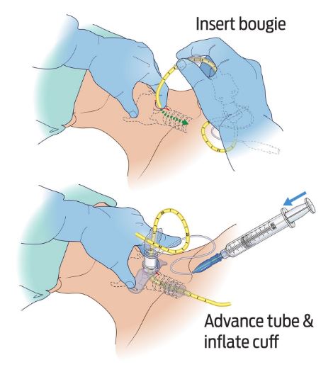 BAC-Pack - Bougie Aided Cricothyroidotomy Pack - North American Rescue®